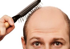 علائم ریزش مو | همه چیز درباره ریزش مو | درمان سریع ریزش مو